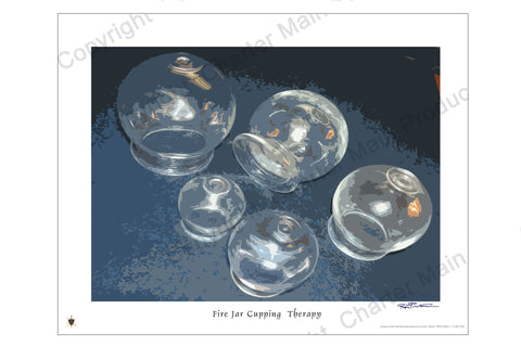 Poster-Five Glass Fire Jar Cups-History-Evolution-Cupping Therapy